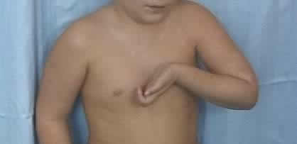 Paralisia do plexo braquial em criança.
Foto: Hospital SOS Mão Recife